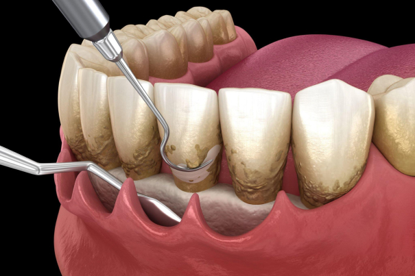 Periodontal Surgery